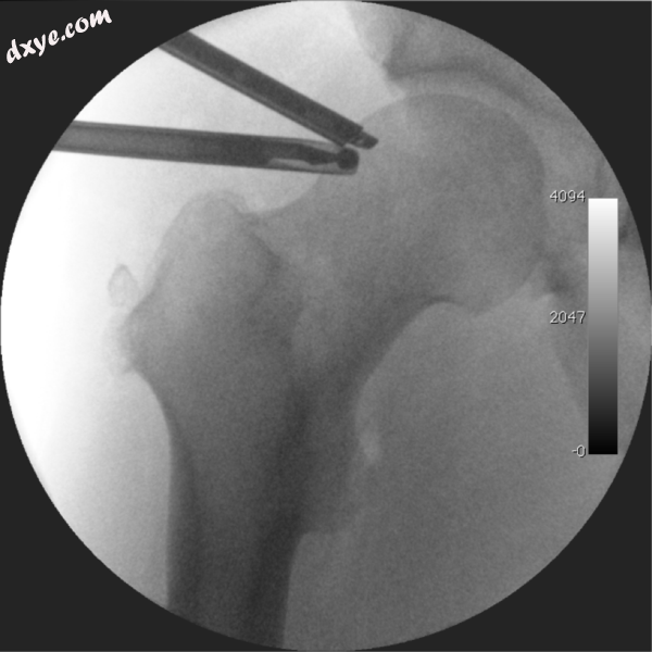 Intraoperative fluoroscopic image during an arthroscopic resection of a cam lesi.png