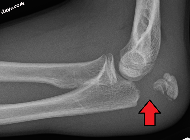 Fracture of the olecranon.png