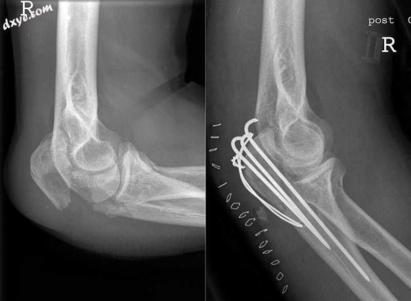 Fracture (left) and repair (right) with three pins, wires, and incision closure .jpg