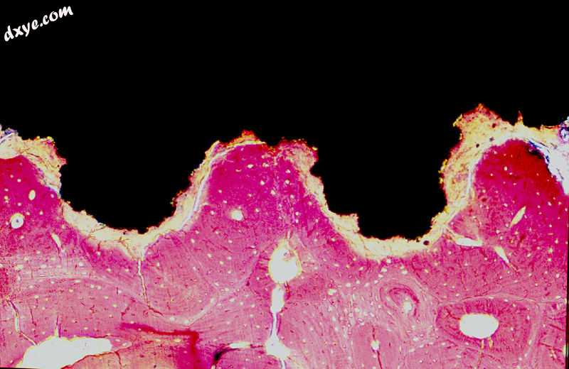 Titanium implant (black) integrated into bone (red).jpg