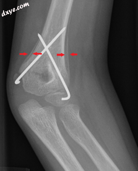 Periostal reaction on a healing supracondylar fracture.png