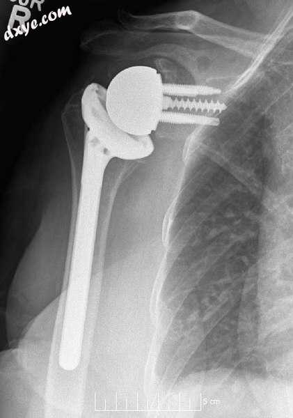 Plain film radiograph in anteroposterior (AP) view of a right shoulder status po.jpg