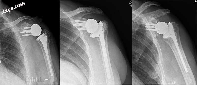 Plain film radiographs in anteroposterior (AP) view of left shoulders that are s.jpg
