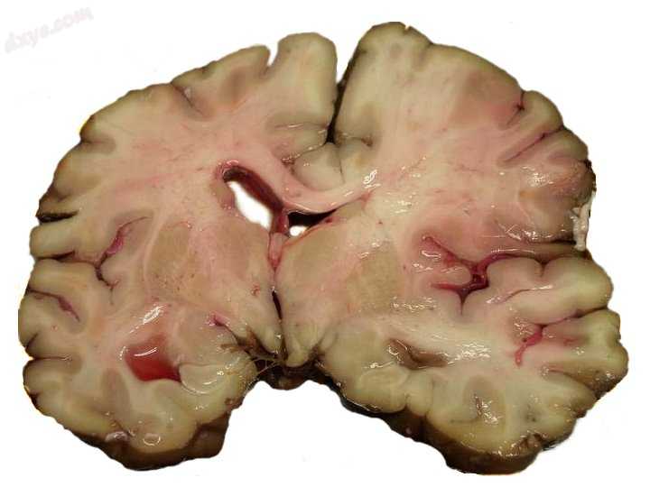 MCA-Stroke-Brain-Human-2.jpg