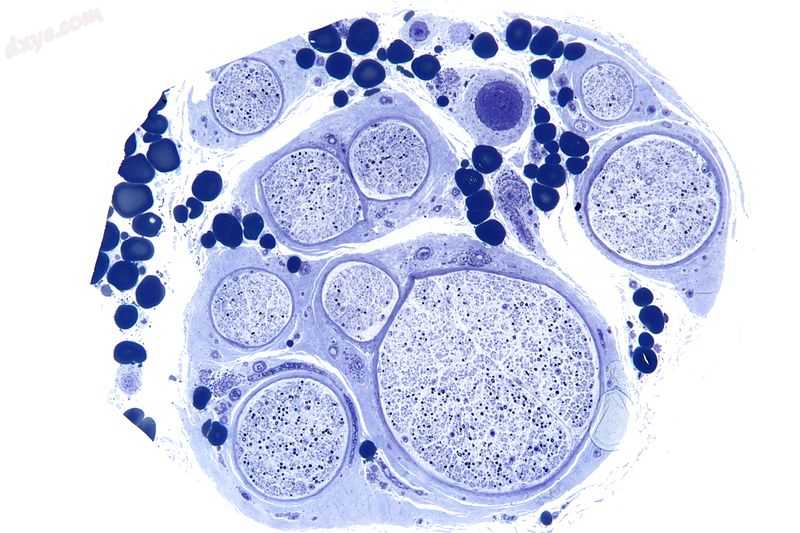 Micrograph of a vasculitic neuropathy. Plastic embedded. Toluidine blue stain..jpg