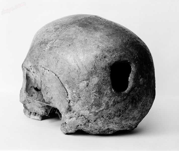 Edinburgh Skull, trepanning showing hole in back of skull Wellcome M0009393.jpg