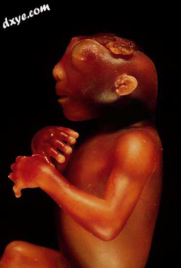 Anencephaly is the most common presentation of neural tube defects[138].jpg