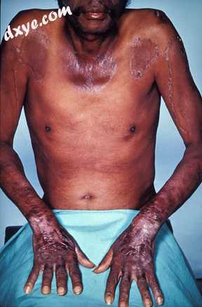 Pellagra initially presents as dermatitis.jpg