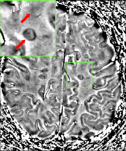 The part of the picture emphasized shows the lesion in the brain. This type of l.png
