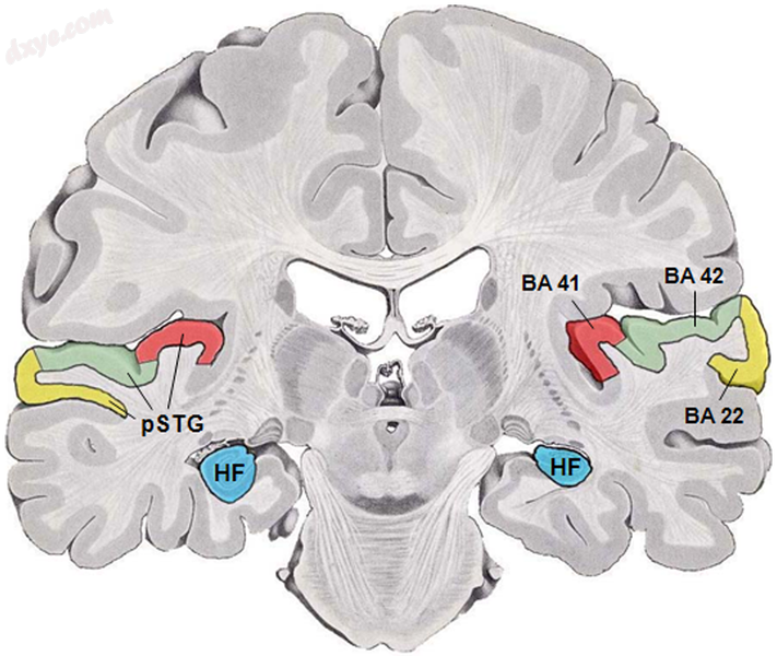 Coronal section of a human brain. BA41(red) and BA42(green) are auditory cortex..png