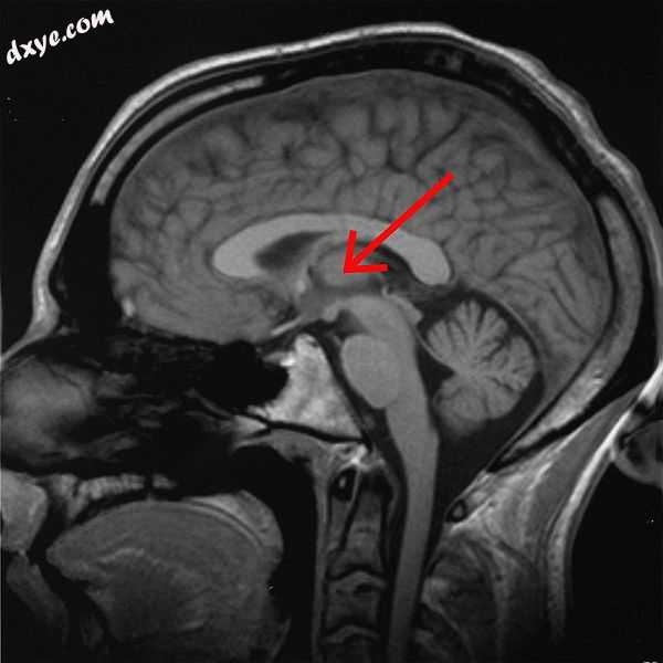 丘脑 marked (MRI cross-section).jpg