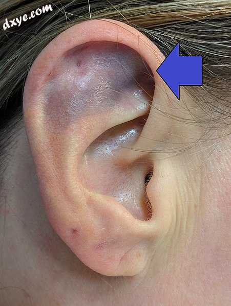 A mild auricular hematoma after drainage.jpg