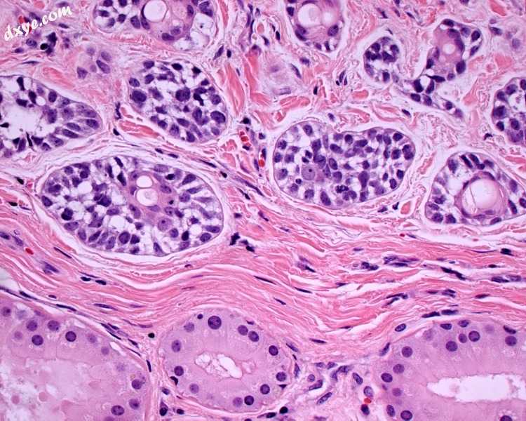 A high power photomicrograph of a ceruminous type 腺样体 cystic carcinoma.jpg