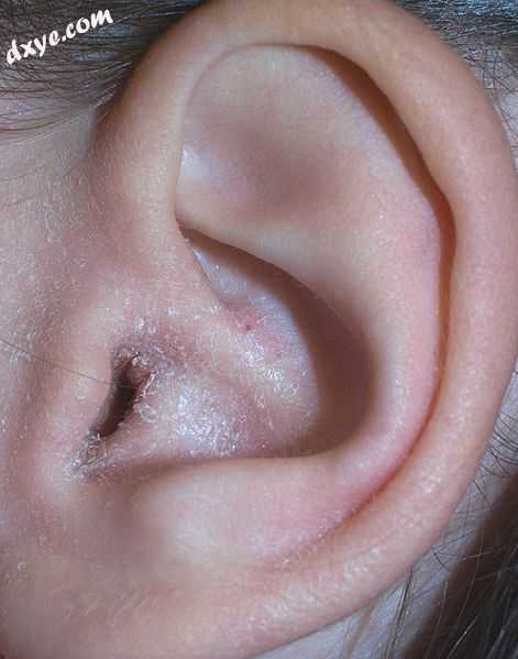 Auricular eczema.jpg