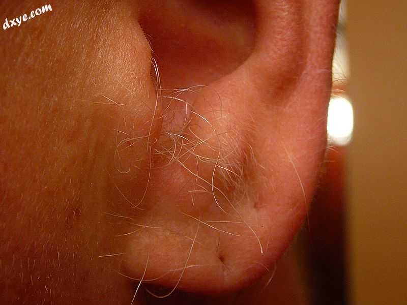 Ear hair protruding from the external auditory meatus in a middle-aged male. Not.jpg