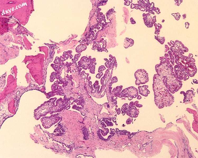 An intermediate power image of an endolymphatic sac tumor with bone (upper left)..jpg