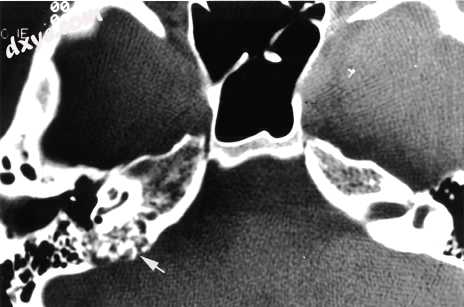 CT in patient with VHL syndrome through the petrous ridge demonstrates bone eros.jpg