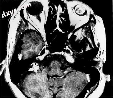 Post contrast T1 weighted MRI demonstrates intense enhancement of both the eye a.jpg