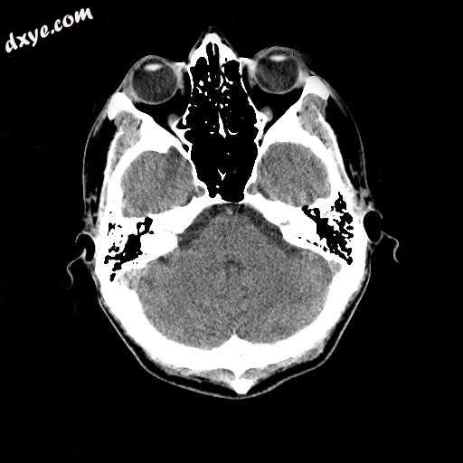 Normal human brain CT scan.jpg