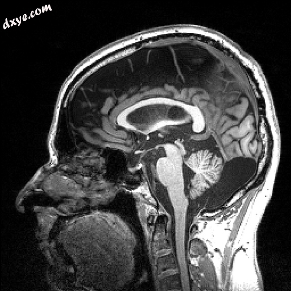 Sagittal view of a human brain through MRI.png