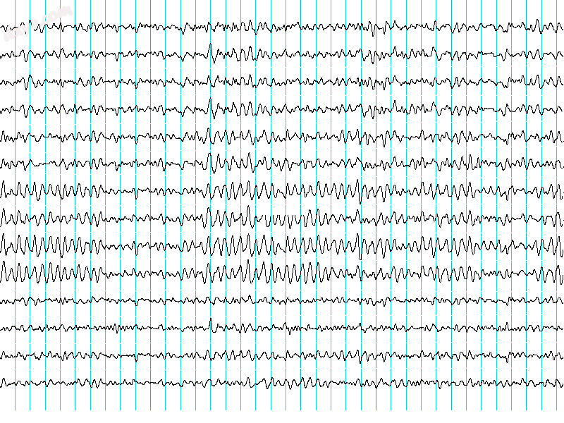 Recordings of brainwaves produced by an electroencephalogram.png