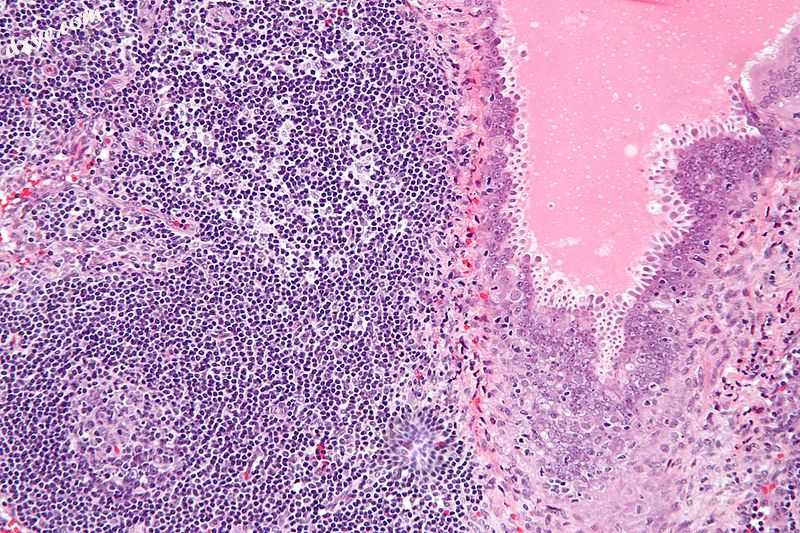 Micrograph showing 输卵管子宫内膜异位 in a lymph node. H&amp;E stain..jpg