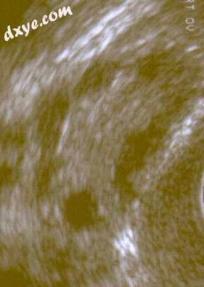 A polycystic 卵巢 shown on an ultrasound image..jpg