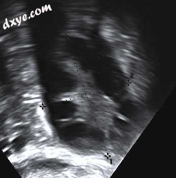 Polycystic 卵巢 as seen on sonography.jpg