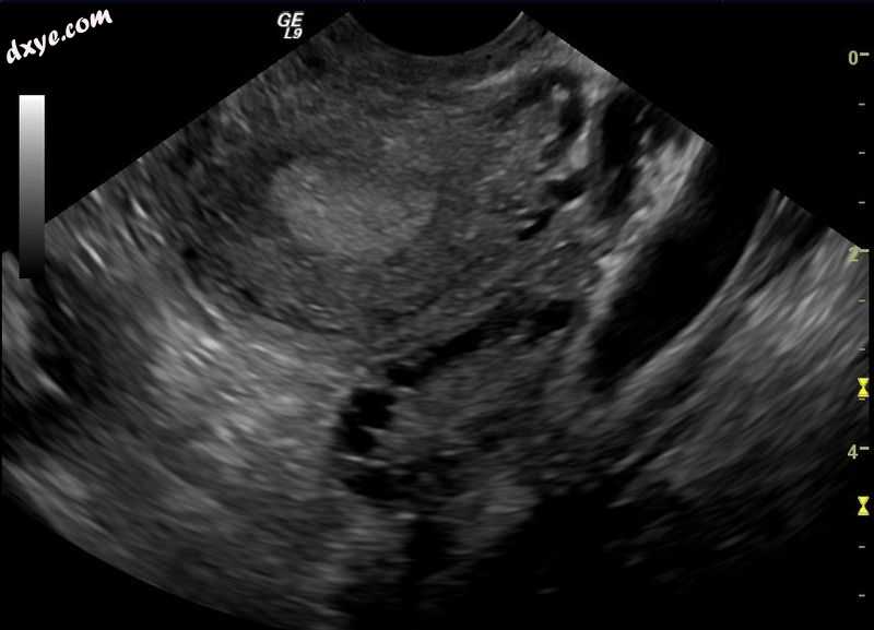 Transvaginal ultrasound scan of polycystic 卵巢.jpg
