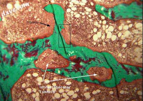 Histology of bone showing 囊状纤维性骨炎. (Fibrosis and intratrabecula.jpg