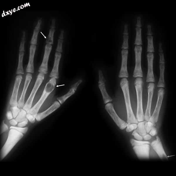X-ray of the hands showing brown tumors in the long bones of the fingers.jpg