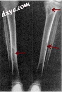 囊状纤维性骨炎 of the tibia. Arrows point to the brown tumors which ar.jpg