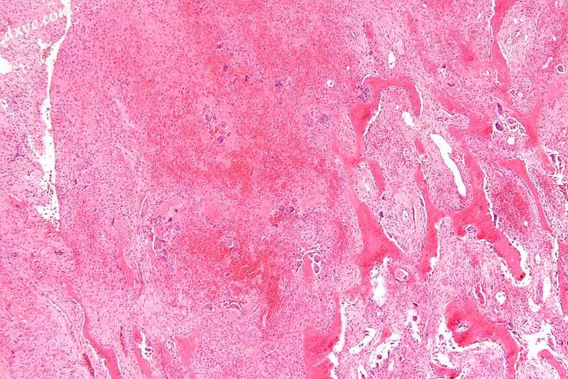 Micrograph of a 棕色瘤 (left of image). H&amp;E stain..jpg