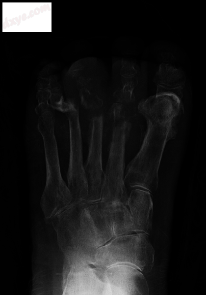 Extensive osteomyelitis of the forefoot.png