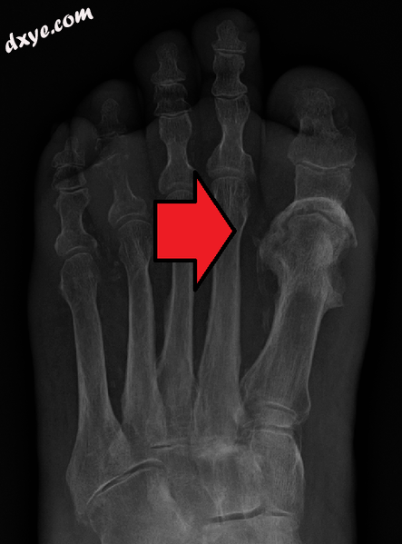 Osteomyelitis of the 1st toe.png