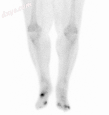 Osteomyelitis in both feet as seen on bone scan.png