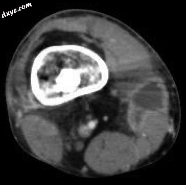 Mycobacterium doricum osteomyelitis and soft tissue infection. Computed tomograp.jpg