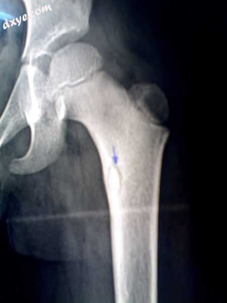 An X-ray of a child&#039;s femur showing a bony sequestrum highlighted by the bl.jpg