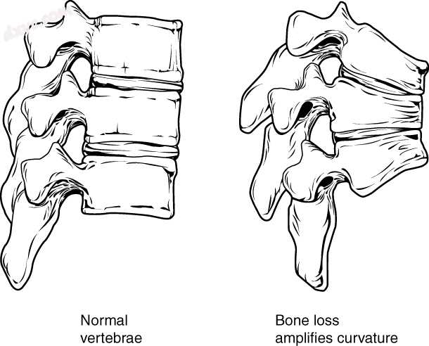 Collapse of vertebra on the right, normal on the left.jpg