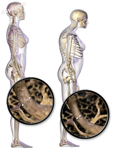 Illustration depicting normal standing posture and osteoporosis.png