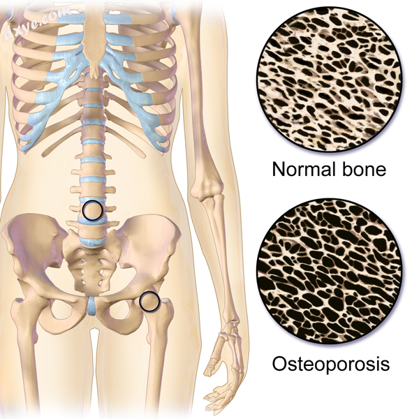 Osteoporosis locations.png