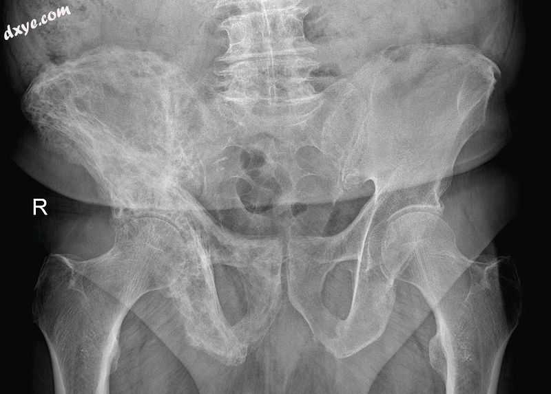 Paget&#039;s disease of right innominate bone. Man of 80 years age..jpg