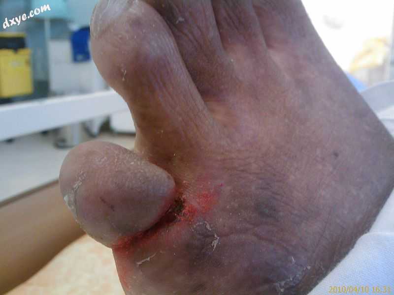 阿洪病 of the left foot of a Zulu patient in Ngwelezane Hospital, KZN, South Afr.jpg