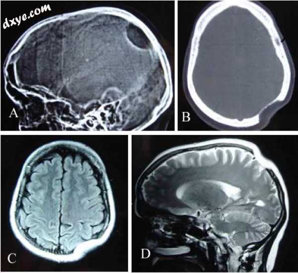 Gorham&#039;s disease involving the left parietal bone.jpg