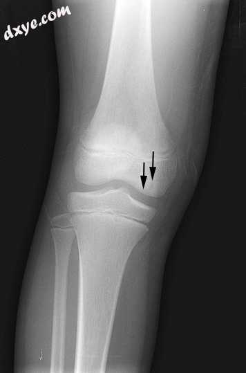 Front X-ray of right knee of an adolescent (epiphyseal plates are open).jpg