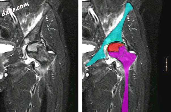 Nuclear magnetic resonance of 缺血性坏死 of left femoral head. Ma.jpg