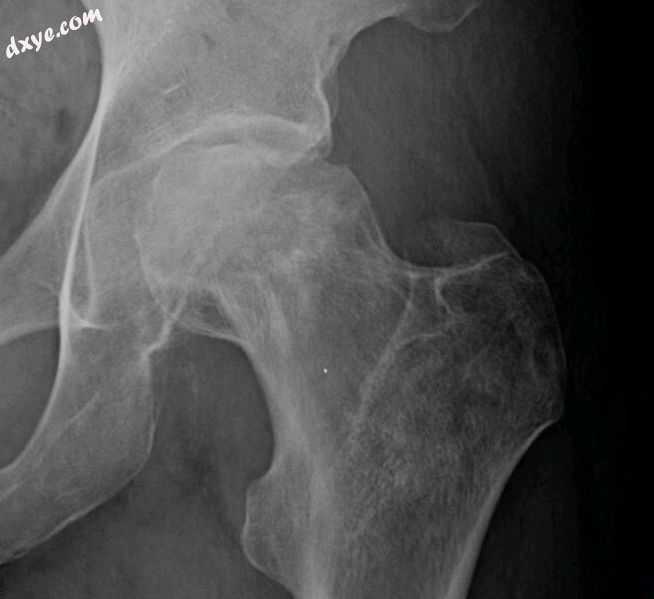 Radiography of 缺血性坏死 of left femoral hea.jpg