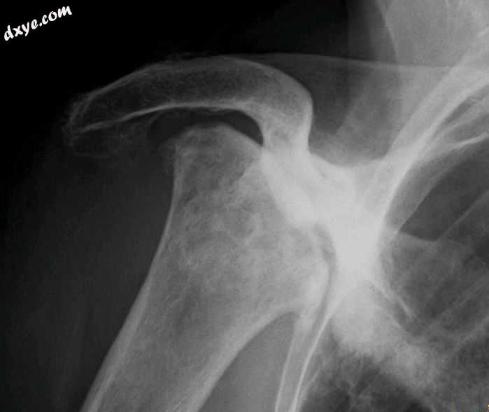 Radiography of total 缺血性坏死 of right humeral he.jpg
