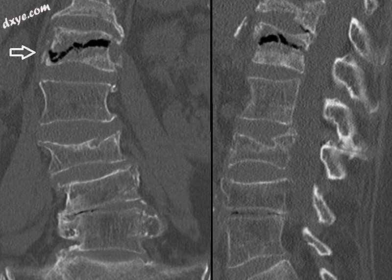 The intravertebral vacuum cleft sign (at white arrow) is a sign of avascular.jpg