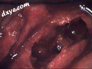 颚骨坏死 of the upper left jaw in a patient diagnosed with chron.jpg